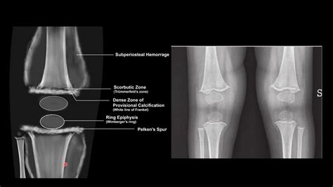 Rickets Disease X Rays