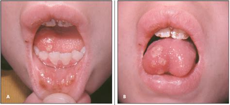 Oral Herpes Inside Mouth Telegraph