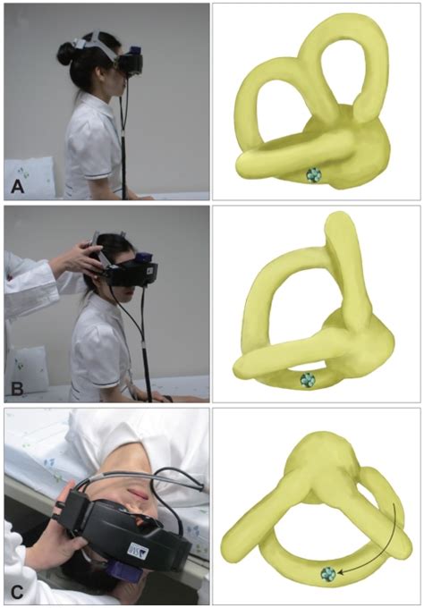 Dix Hallpike Maneuver For The Diagnosis Of Bppv Involving The Right