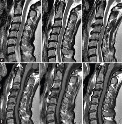 We did not find results for: Conservative management of a cervical ligamentum flavum ...