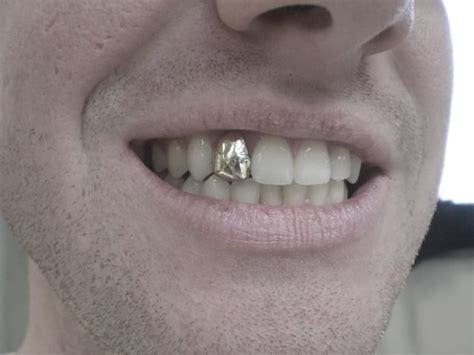 Taller trees are more costly to remove. How Much Does Permanent Gold Teeth Cost?