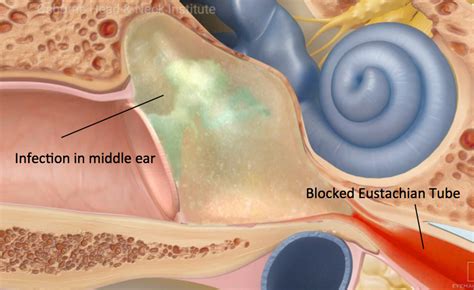 Ear Infections Treatment Los Angeles Ca
