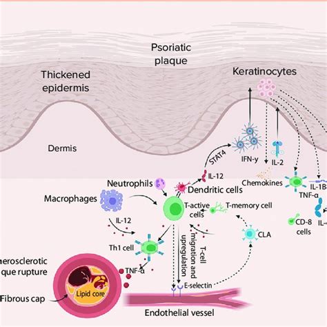The Pathogenesis Of Psoriasis And Its Association With Atherosclerotic