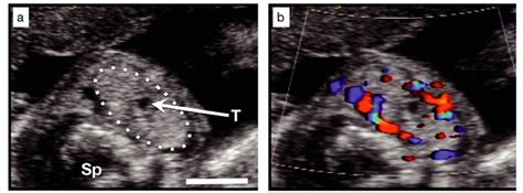 Sonographic Features Of A Fetal Goitor A Transverse View Of The Fetal