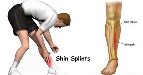 ®yuzon Shin Splints Syndrome
