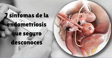 los síntomas de la endometriosis que quizá desconozcas