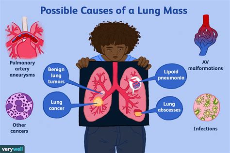 Possible Causes of a Lung Mass