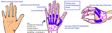 Broken Hand Metacarpal Fracture — Bone Talks