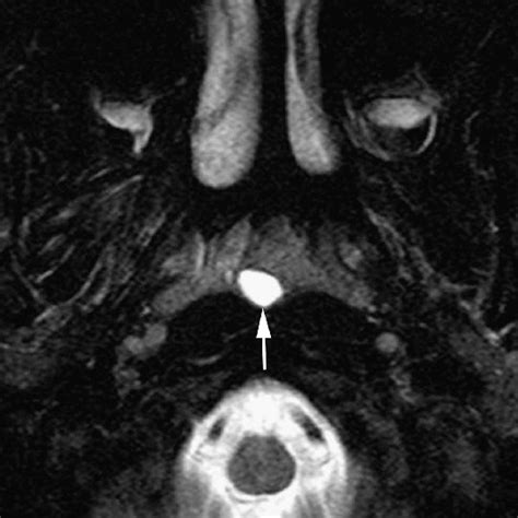 Example Of A Cystic Lesion Suggestive Of Mucous Retention Cyst In The