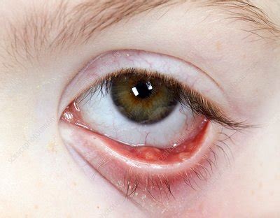 Chalazion In The Lower Eyelid Stock Image C Science Photo
