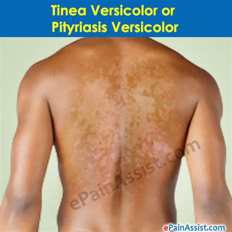 Tinea Versicolor Vs Eczema