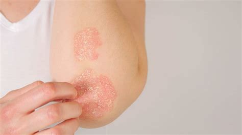 skin condition of the month psoriasis