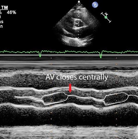 Causes Of Aortic Stenosis Critical Care Sonography