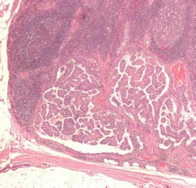 Head and neck cancers seem to sneak up on people, so if. What Does Thyroid Cancer Look Like On Ultrasound Pic