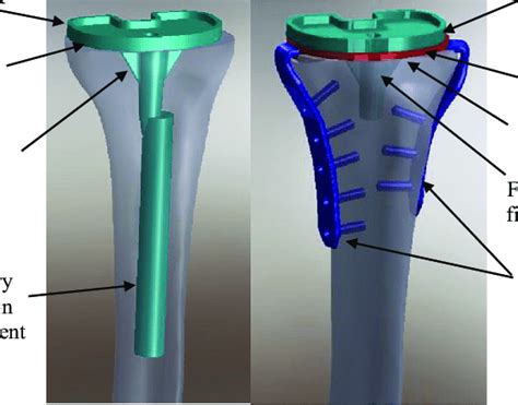 Representative Cad Images Of The Implants Used A Tibial Component