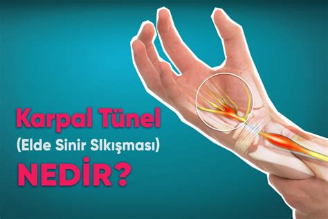 Elde Sinir S K Mas Karpal T Nel Sendromu Nedir Belirtileri