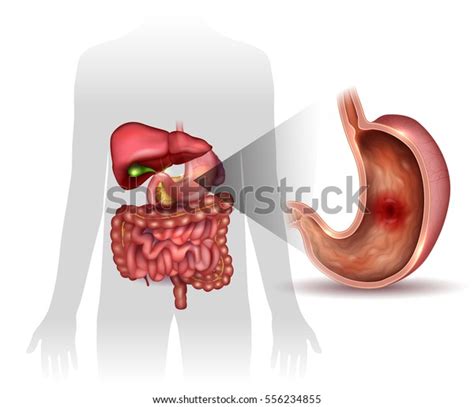 Stomach Ulcer Interanal Organs Anatomy Colorful Stock Vector Royalty Free 556234855