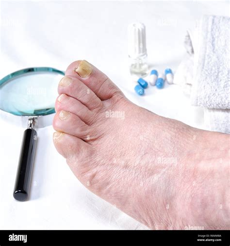Deformed Toenail Hi Res Stock Photography And Images Alamy