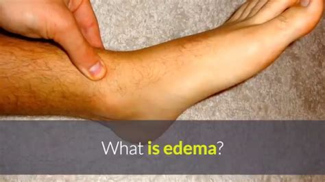 What Is Edema Causes Of Edema Youtube