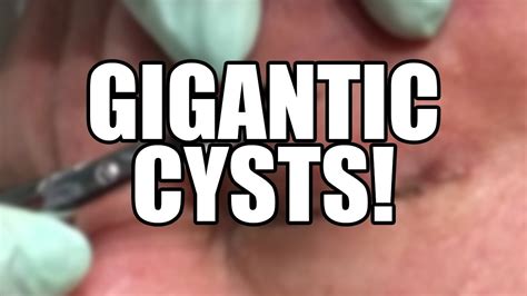Gigantic Dermoid Cysts Pimple Popping And Acne Video Youtube