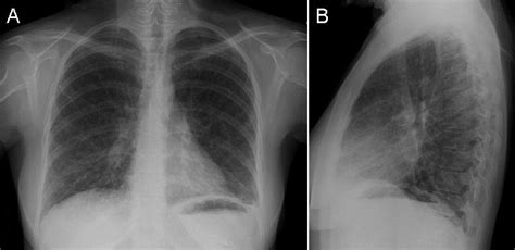 Southwest Journal Of Pulmonary Critical Care And Sleep Pulmonary