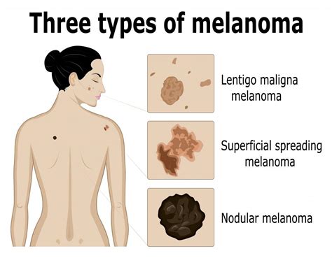 Was Sie über Melanom wissen sollten DEMedBook