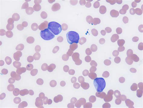 Peripheral Blood Smear Showing Immature Myeloid Cells