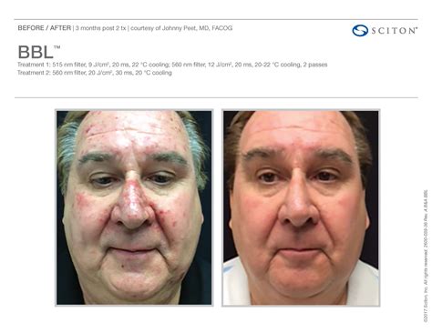 Sciton Bbl Mens Facial Rejuvenation Skin Care Procedures Facial