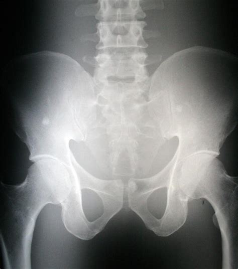 Sacroiliac Joint X Ray