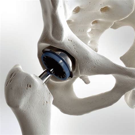 Hip Replacement Surgery The More Clinics