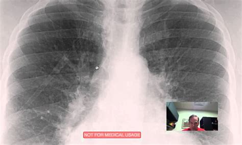 Cxr Pulmonary Vascular Congestion Discussed By Radiologistmp4 Youtube