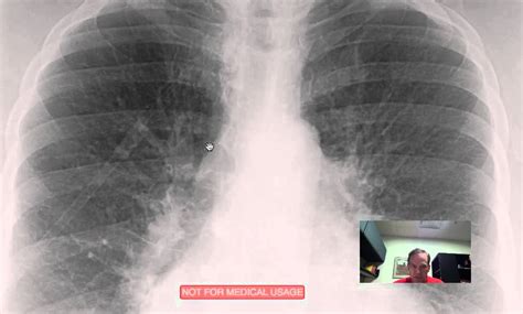 Congestão Pulmonar Raio X