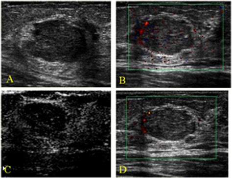 Breast Cancer Malignant Ultrasound Images