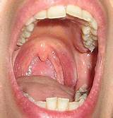 Images of Tongue Fungus Home Remedies