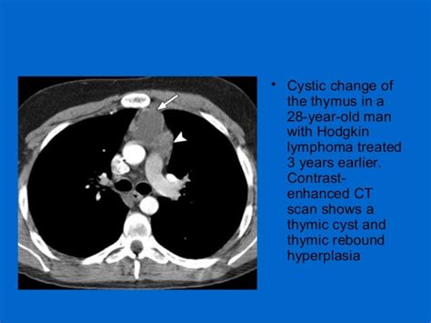 Understanding The Thymus