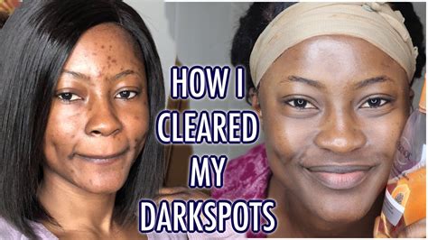 How To Clear Dark Spots Affordable Skincare Routine Ft Generation
