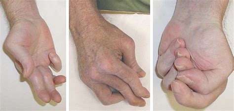 Striatal Deformities Of The Hand And Foot In Parkinsons Disease The