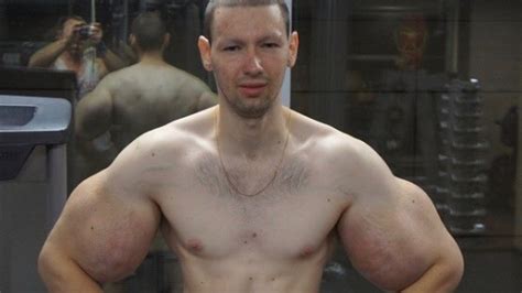 Kirill Tereshin Undergoes Surgery To Shrink 61cm Biceps Popeye Au — Australias