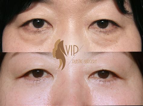 Lower Eyelids Surgery Also Known As Eye Bag Removal Surgery Reduces