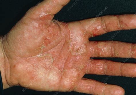 Close Up Of Patients Hands With Discoid Eczema Stock Image M150