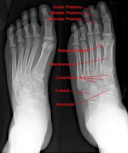 Foot X Ray Normal Findings Bone And Spine
