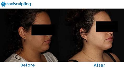 Coolsculpting Before And After Pictures Female Chin