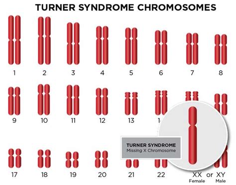 Monosomy X Turner Syndrome Diagnosis Treatment SSM Health