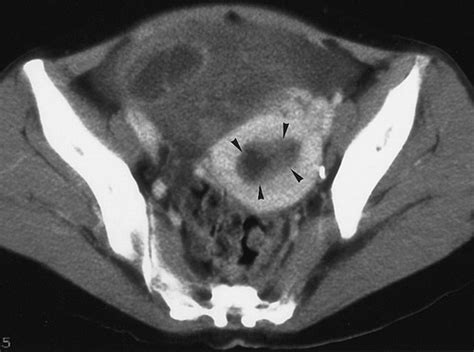 Ct And Mr Imaging Of Ovarian Tumors With Emphasis On Differential