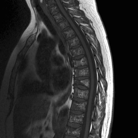 Coronavirus disease programme online course: Multiple myeloma - spine | Radiology Case | Radiopaedia.org