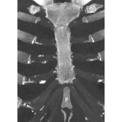 All Fusion Of Sternal Manubrium Body And Xiphoid Process In A