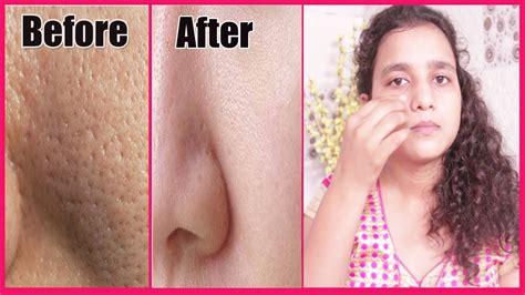 3 Ways To Get Rid Of Large Open Pores Permanently Get Fairer