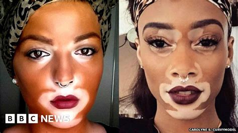 The Model Whos Bringing A Rare Skin Condition Into The Open Bbc News