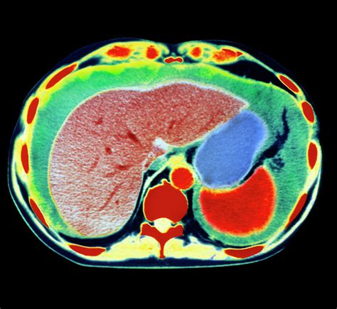 Coloured Ct Scan Showing Ascites Of The Abdomen Photograph By Dept Of