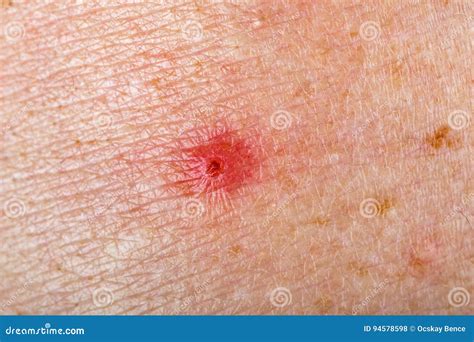Inflamed Red Spot On Skin Stock Photo Image Of Allergy 94578598